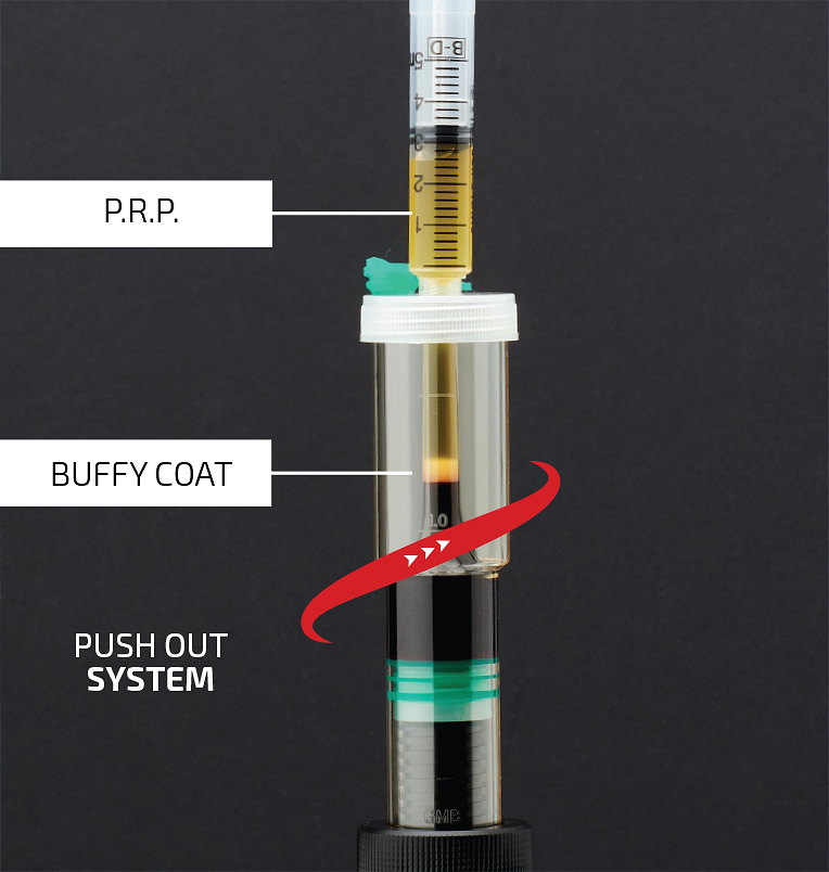 P.R.P. and Buffy coat